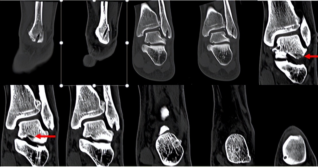 脚踝轻微扭伤如何处理,脚踝轻微扭伤用什么药物