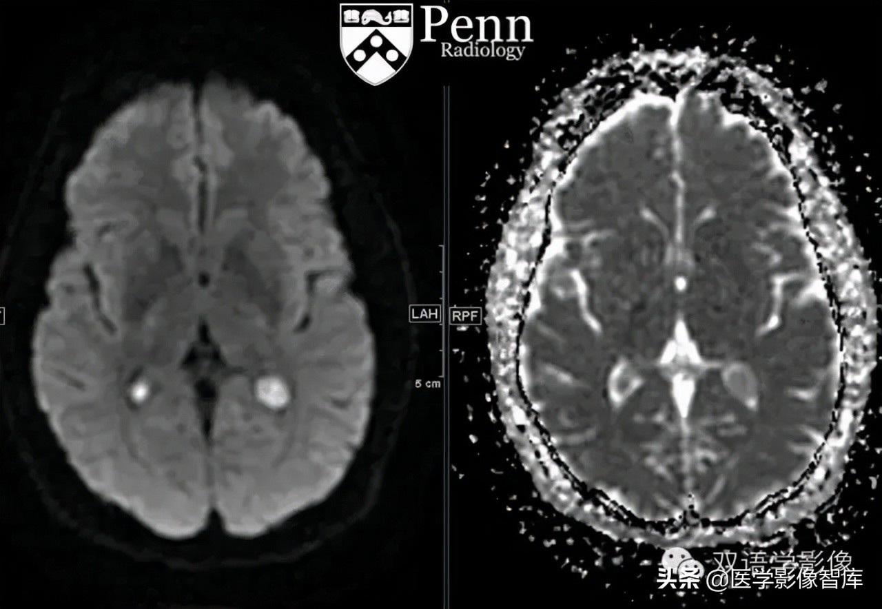 脉络丛黄色肉芽肿的进一步检查,脉络丛黄色肉芽肿有中成药吗