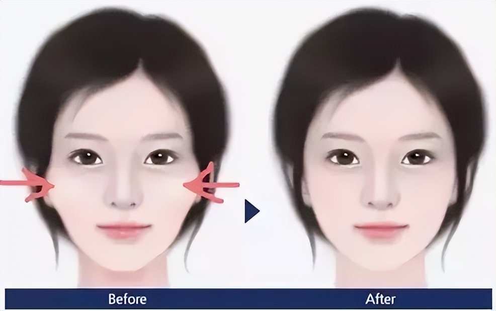 颧骨突出但不外扩面相,颧骨突出外扩男生怎么改善