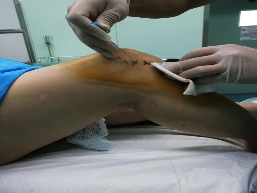 中医特色治疗骨关节炎日间病房开启“即治即走”模式