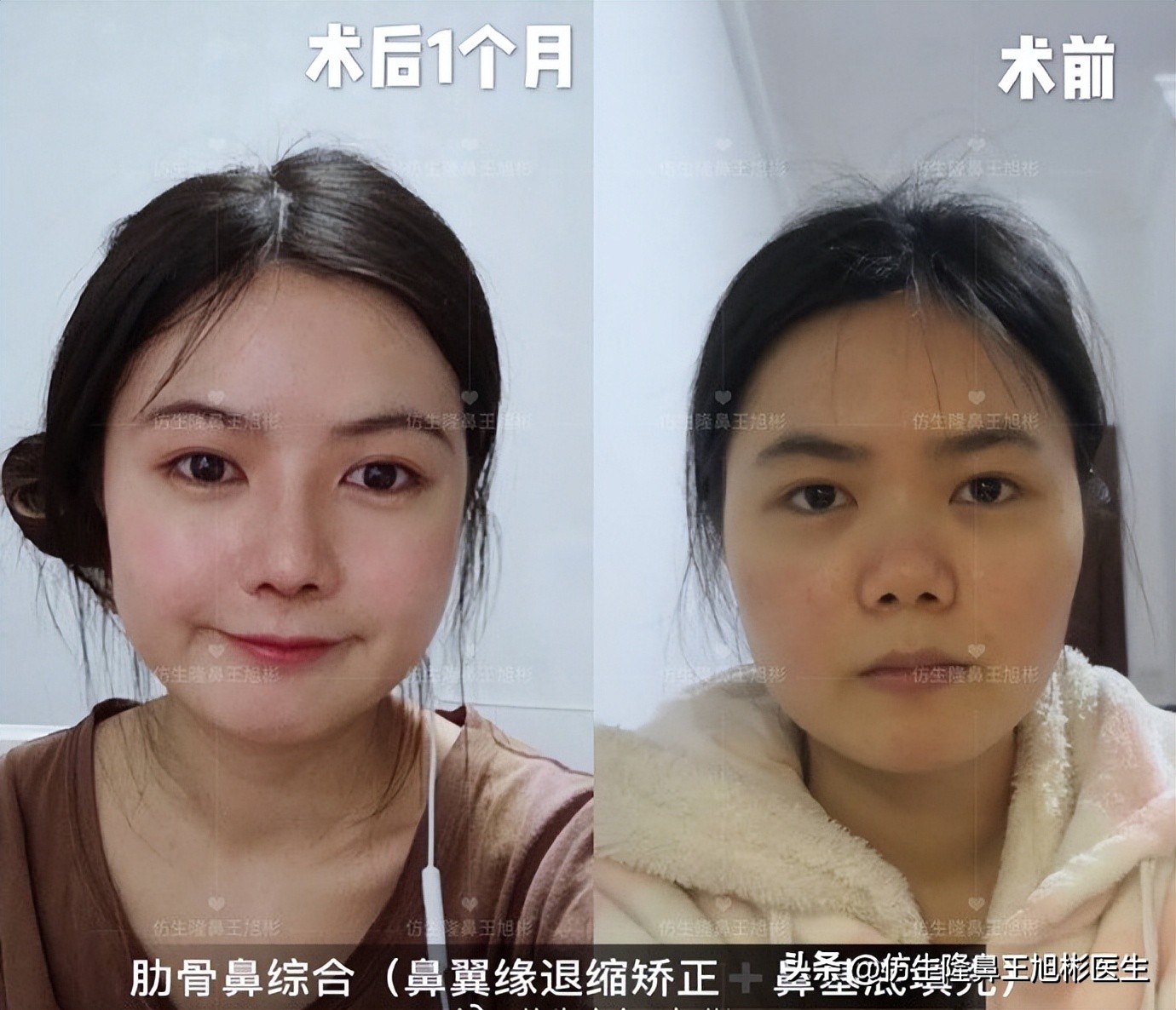 短鼻延长的最佳方法,短鼻修复前后对比案例