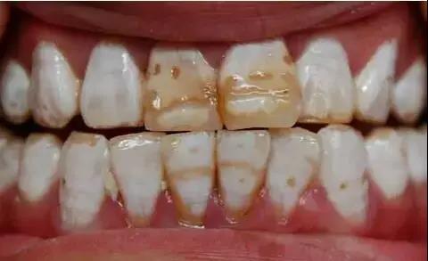 氟斑牙治疗的3种方法,氟斑牙最佳修复方法