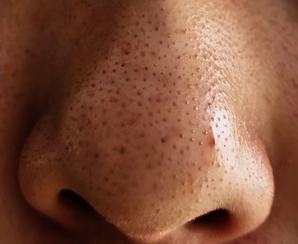 鼻子毛孔大能挤出好多脂肪粒,鼻子上长了像脂肪粒的东西