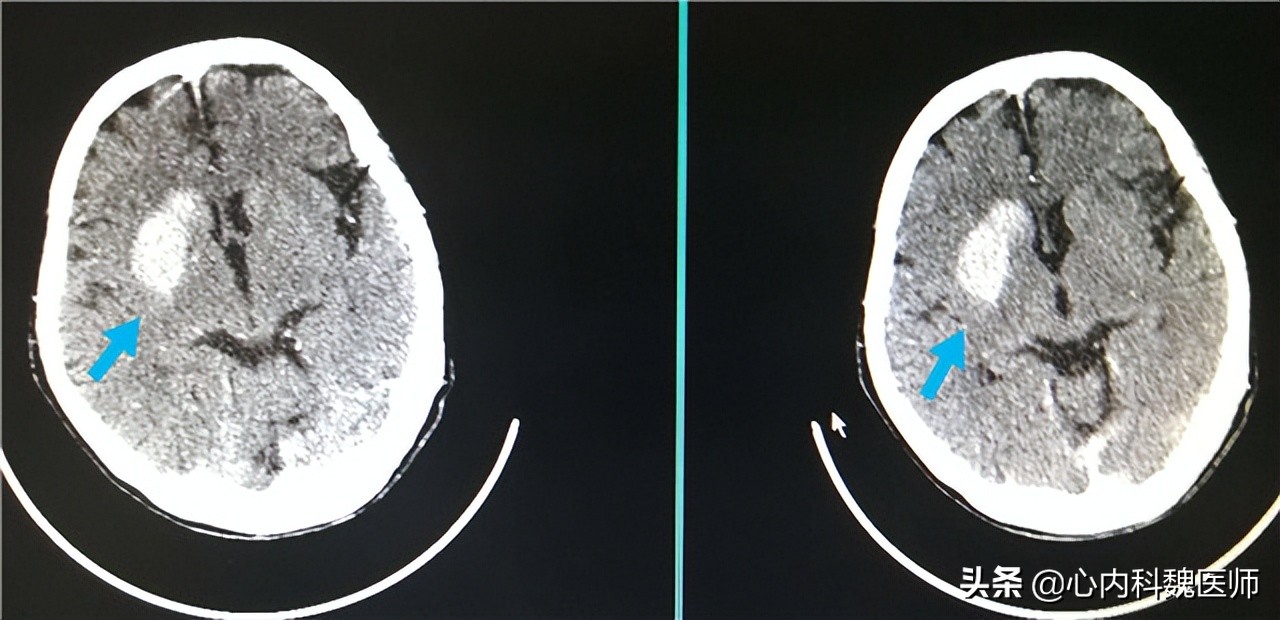 颈动脉斑块多大容易得脑梗,发现颈动脉血栓就离脑梗不远了