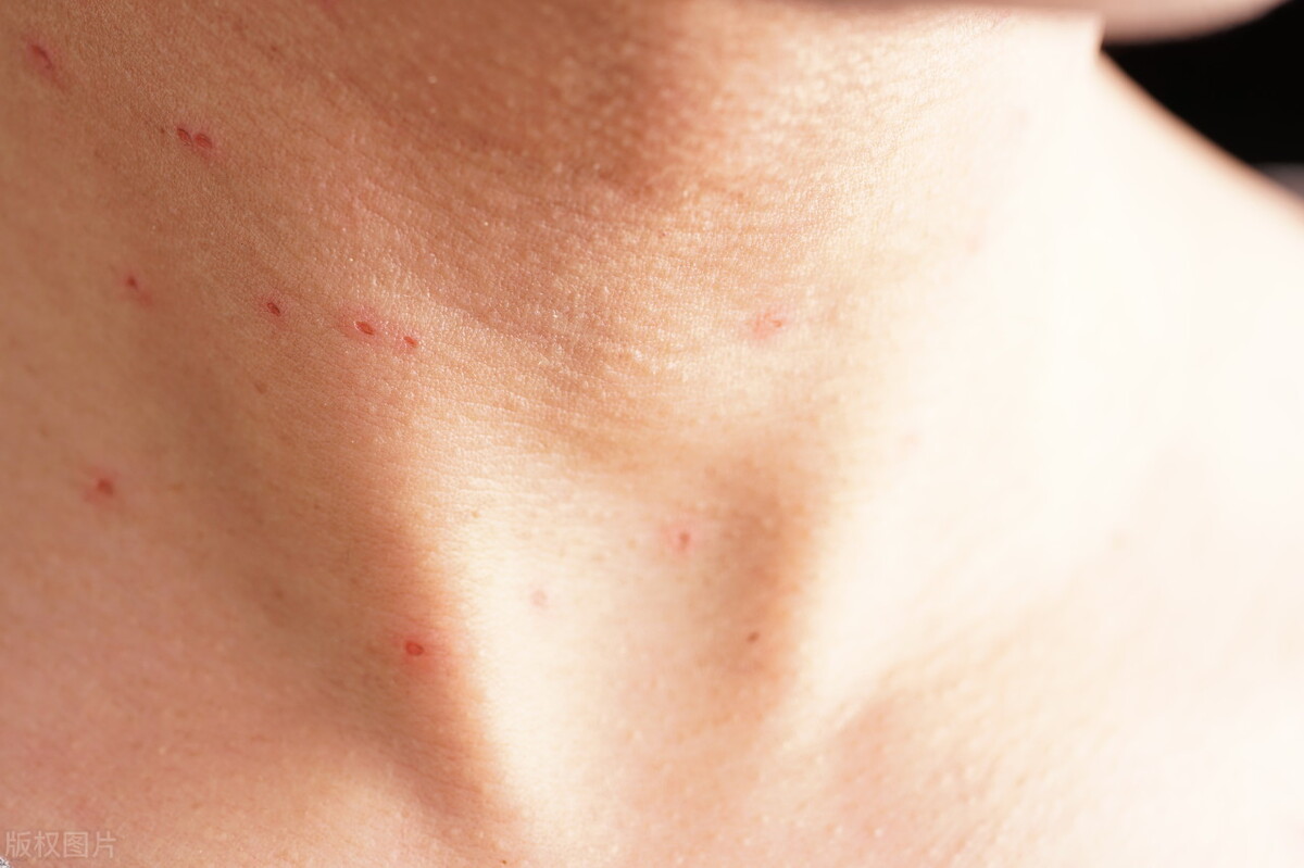 皮肤上的小肉粒是hpv感染吗,身上hpv感染小肉丁如何去除