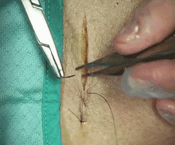 外科各种缝合方法的适用情况,外科操作缝合