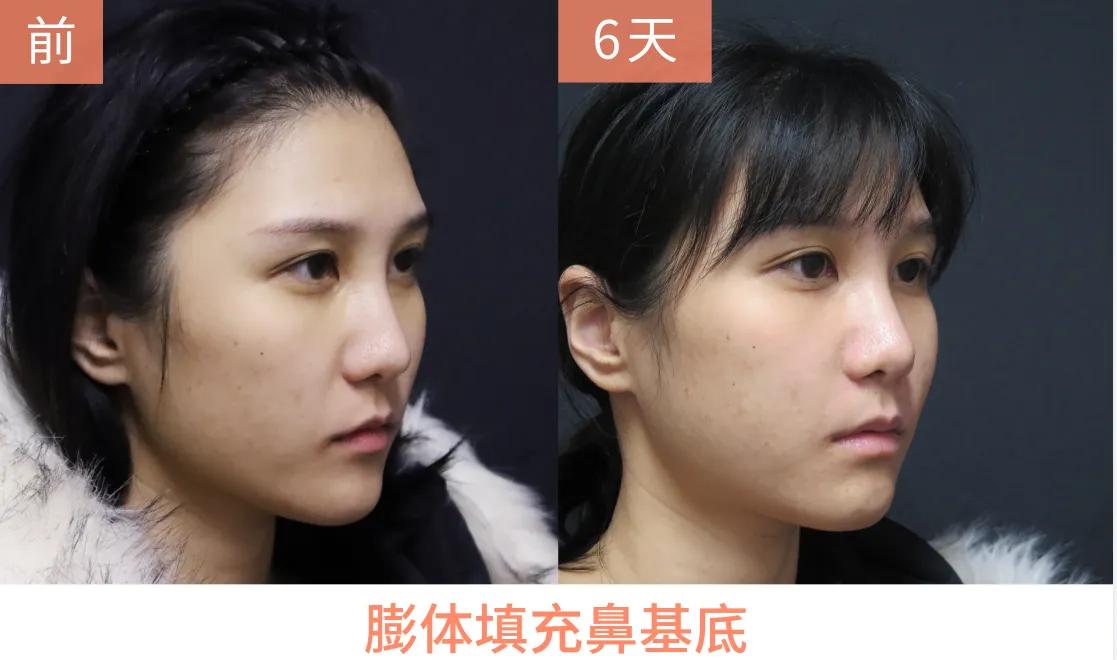 鼻基底少女针填充恢复过程,女25岁隆鼻术后七天全过程分享