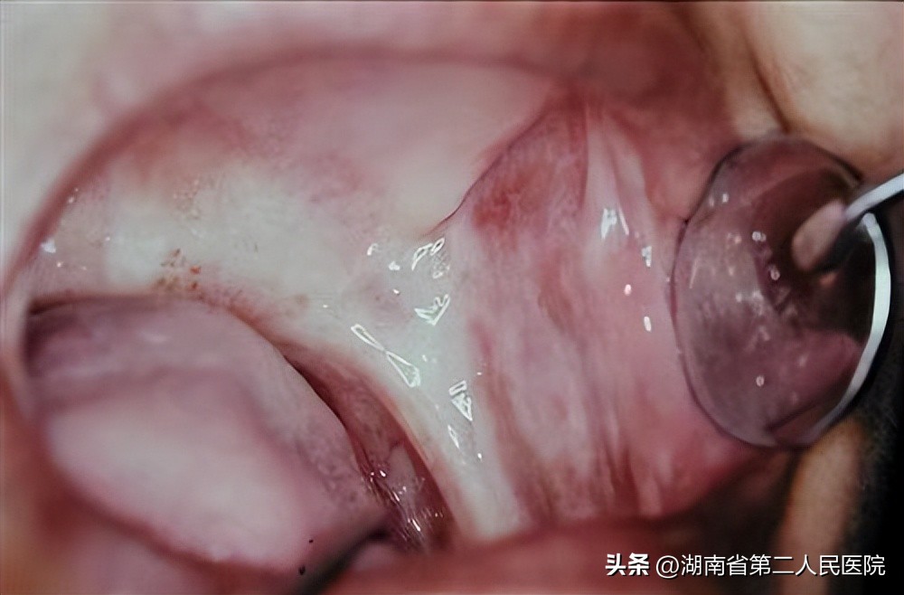 嘴巴越来越张不开什么原因,嘴巴张不开了怎么治好