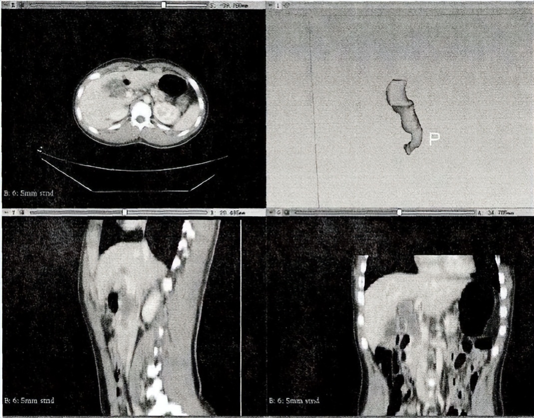 胰胆管合流异常影像诊断,基于影像组学的深度学习