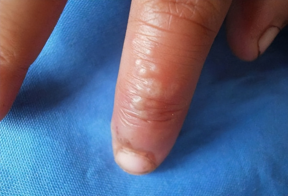 生活中最常见的4种皮肤病,皮肤科可以看多种皮肤病吗