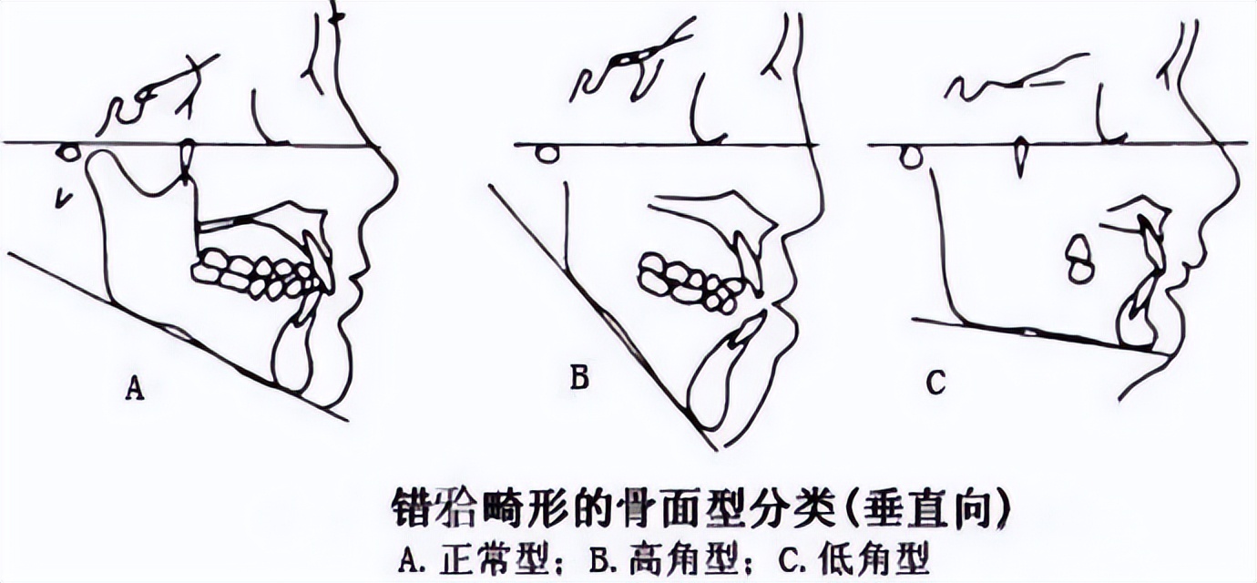 不拔牙矫正嘴凸下巴后缩案例,嘴瘪不拔牙矫正嘴会凸怎么办