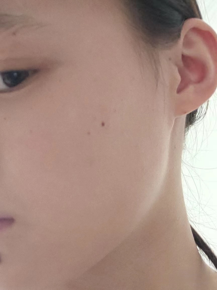 大片痤疮红痘印最快的治疗方法,痘痘反复长脓包不停如何正确祛痘