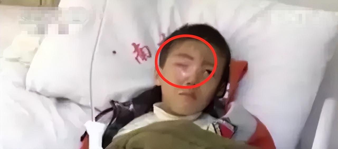 小孩眼珠被熔化了怎么办,震惊八岁男孩眼球20分钟融化