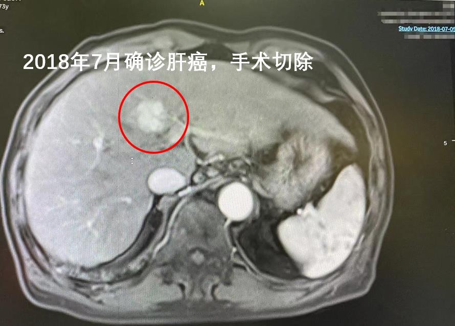 晚期肝癌如何轻松无瘤生活5年？微波消融助力完全“烧死”肿瘤