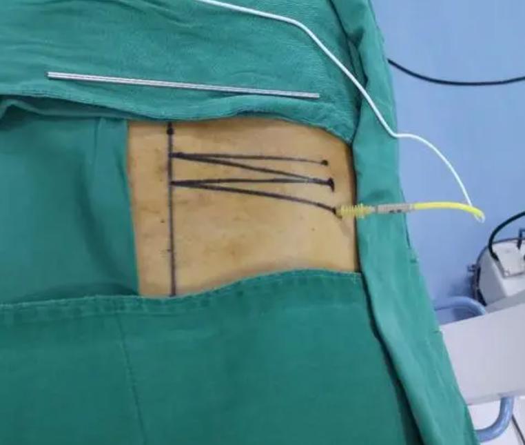 不用开刀的手术是什么手术,不用开刀手术可以治好吗