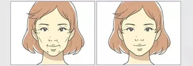 自体脂肪填充泪沟会改善细纹么,自体脂肪填充不满意怎么办