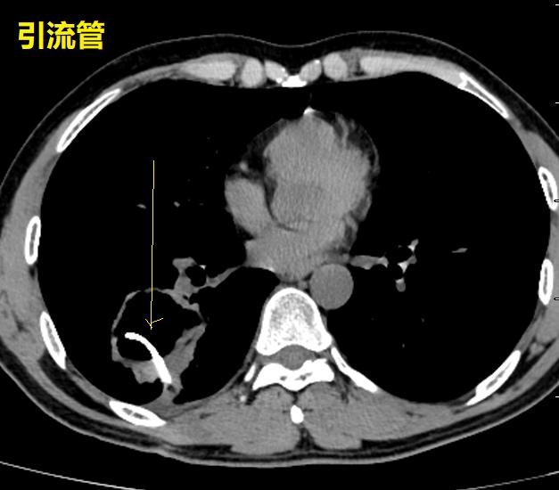 肺脓肿导管引流,肺脓肿的引流管脱落怎么办