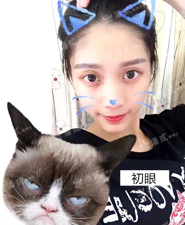 双眼皮贴导致眼皮破了,双眼皮贴导致眼皮严重下垂恢复