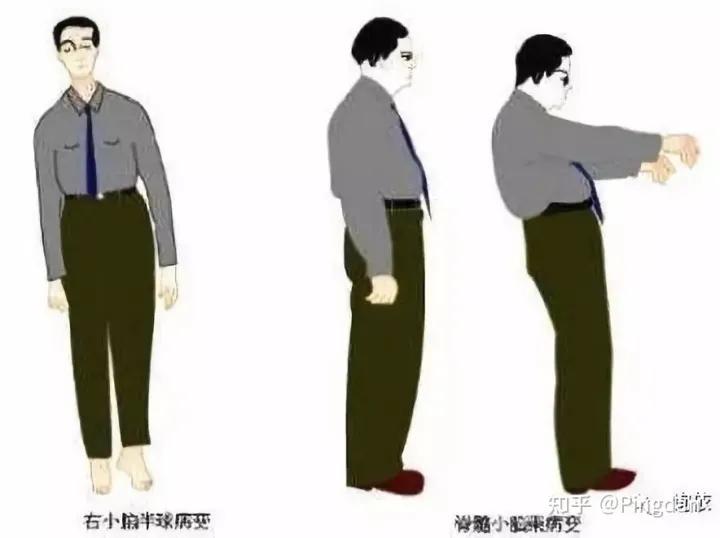 眩晕天旋地转是什么原因,头眩晕天旋地转吃什么药