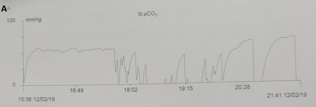 几十年间歇性胸闷气短去哪治疗,胸闷气短三年了怎么回事