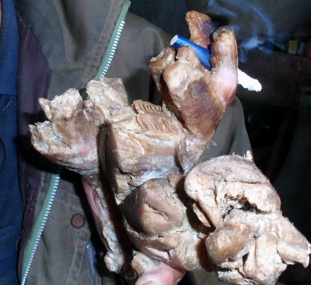 男子手长满树疙瘩是什么病,男子手长满树疙瘩手术了吗