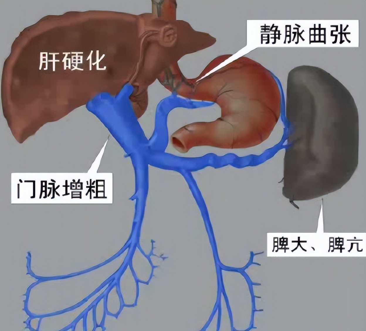 我的左腿深静脉血栓怎么办,医生说我有血栓的征兆怎么办