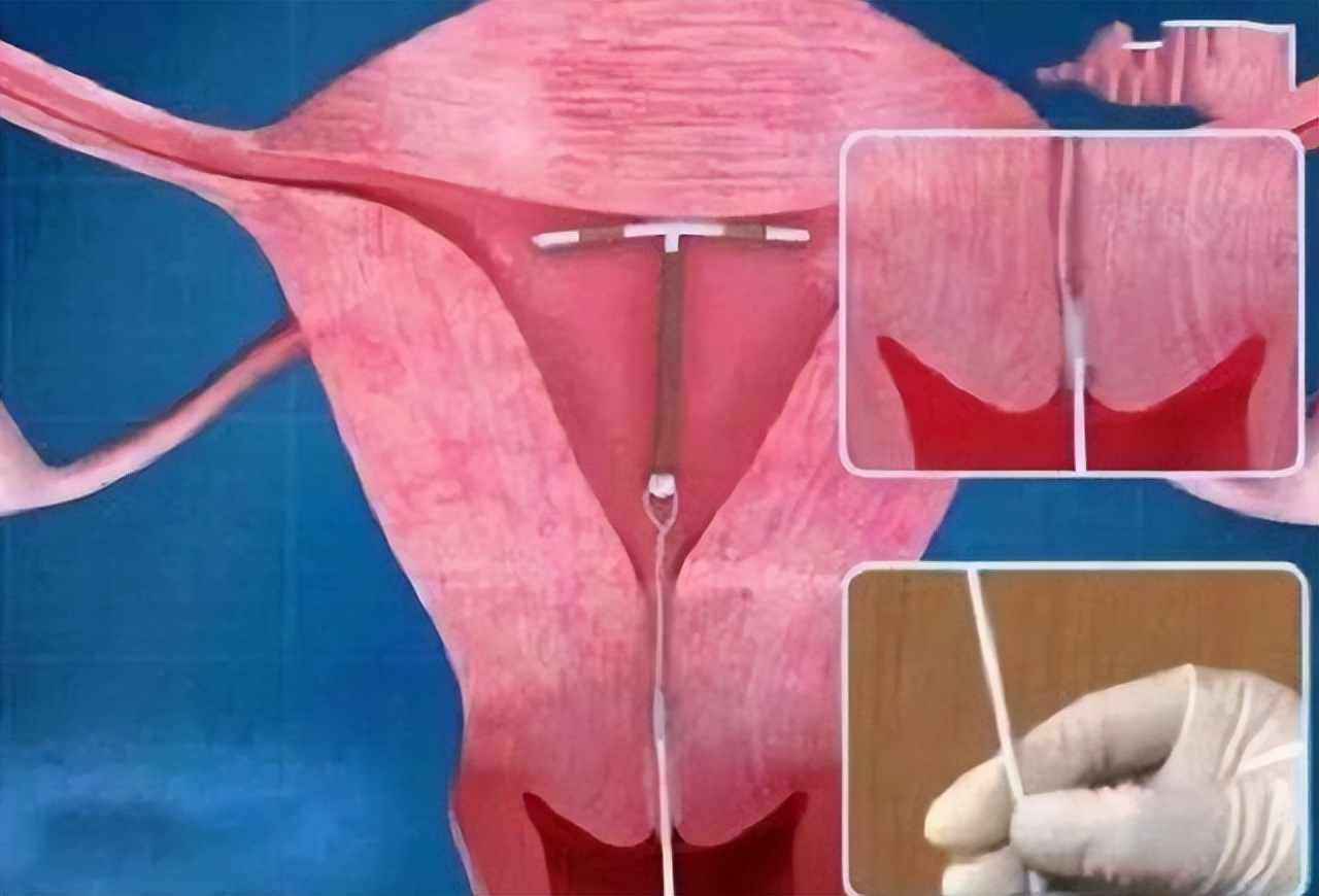 节育环不绝经可以取吗,节育环不取出来会经常肚子疼吗