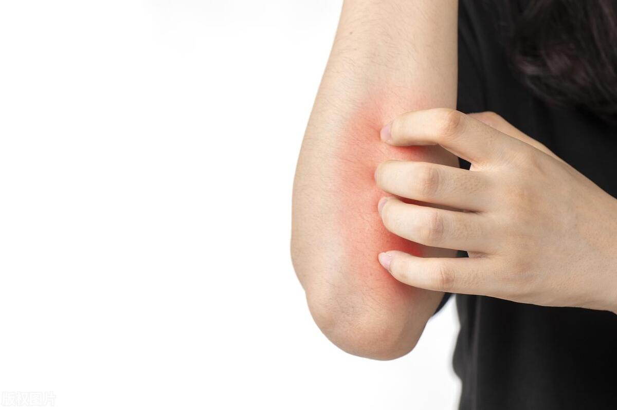 游玩后确诊虫咬皮炎,旅游后过敏