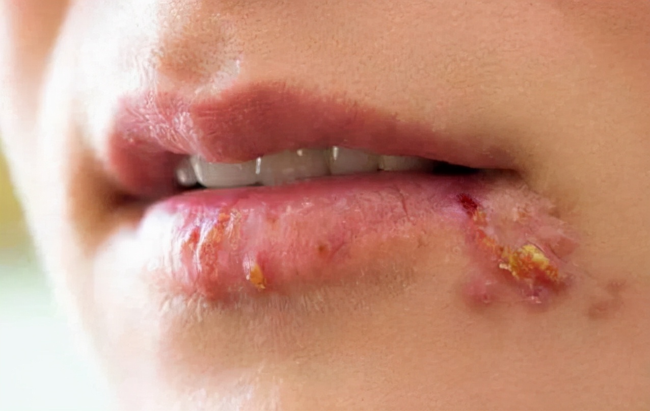 嘴巴旁边很多小水泡会留疤吗,嘴巴周围长一堆小水泡是上火吗