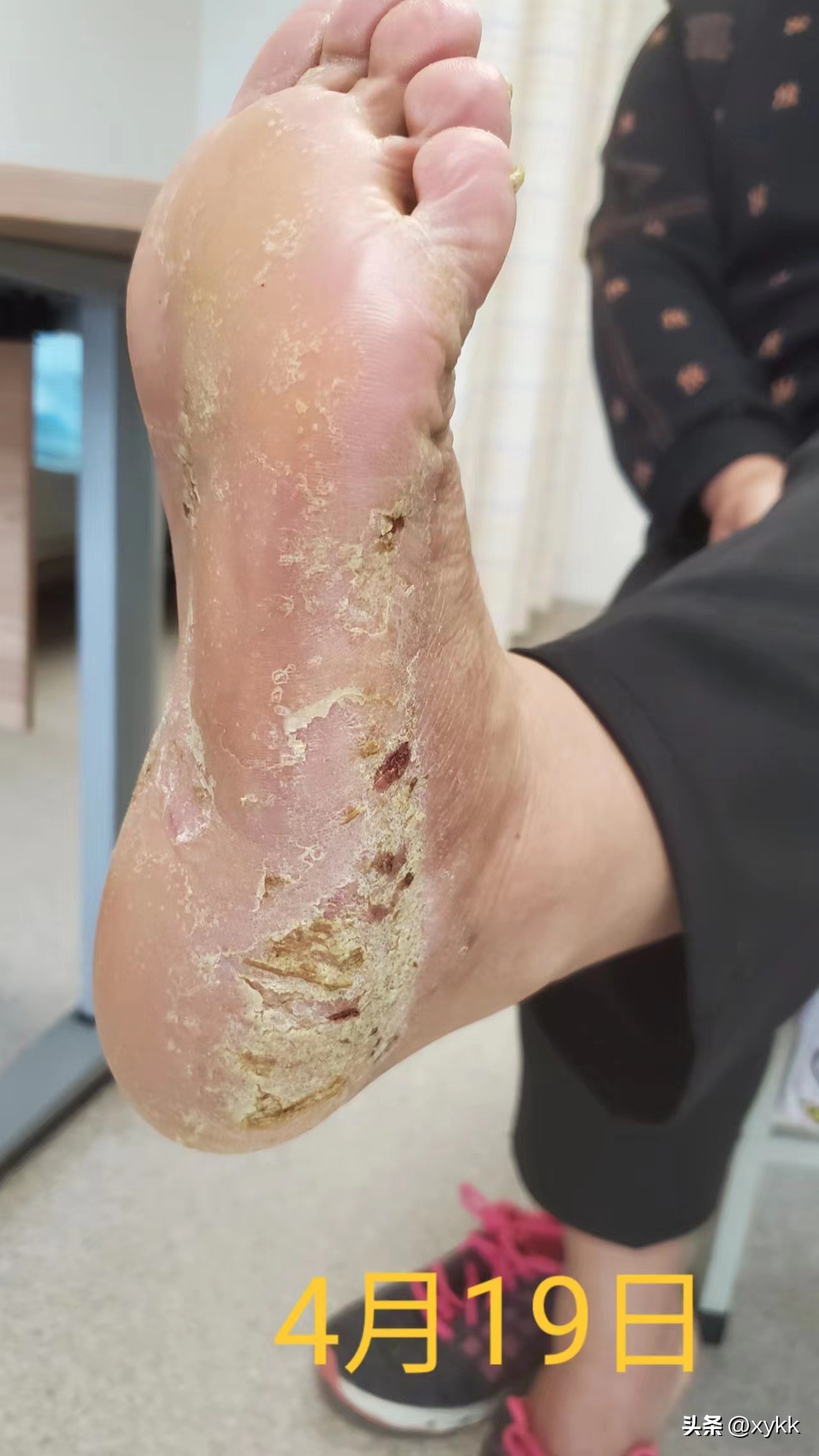 治疗脚部和手部湿疹,调理脾胃治疗湿疹