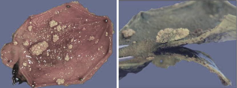 胆囊多发息肉样病变8mm*6mm,胆囊息肉病变0.6严重吗能喝酒吗