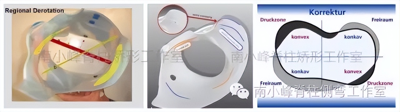 脊柱侧弯多少度会形成剃刀背,脊柱侧弯多少度会出现剃刀背