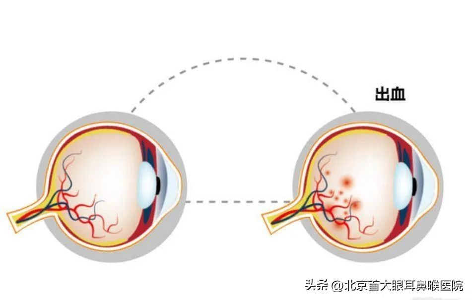 眼底出血是怎么回事？怎么办？北京眼底病哪家医院好？
