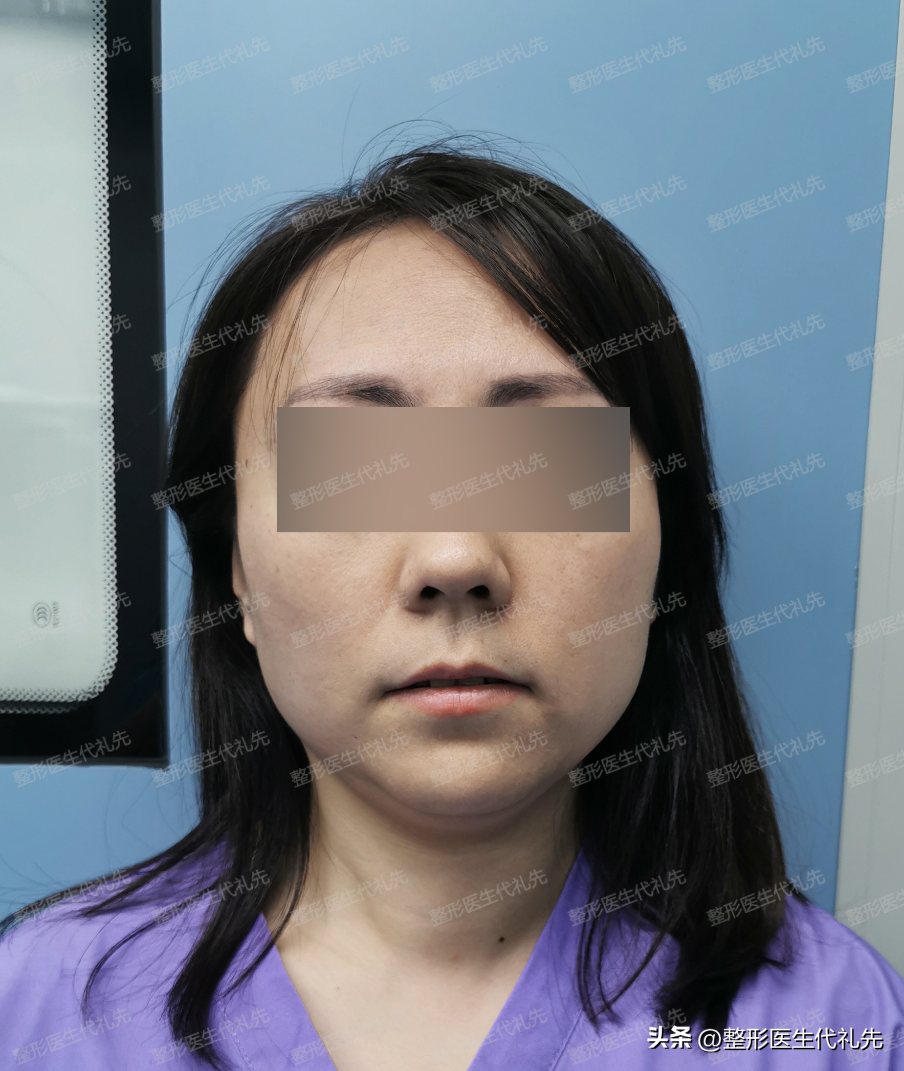 30岁脸部提升紧致最好的手术,最新脸部祛皱提升手术