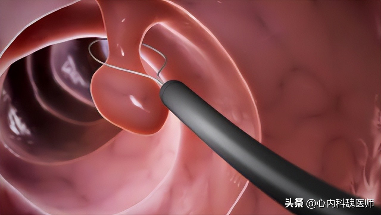 肠息肉切除后半年一定要复查吗,肠息肉切除后多长时间复查合适