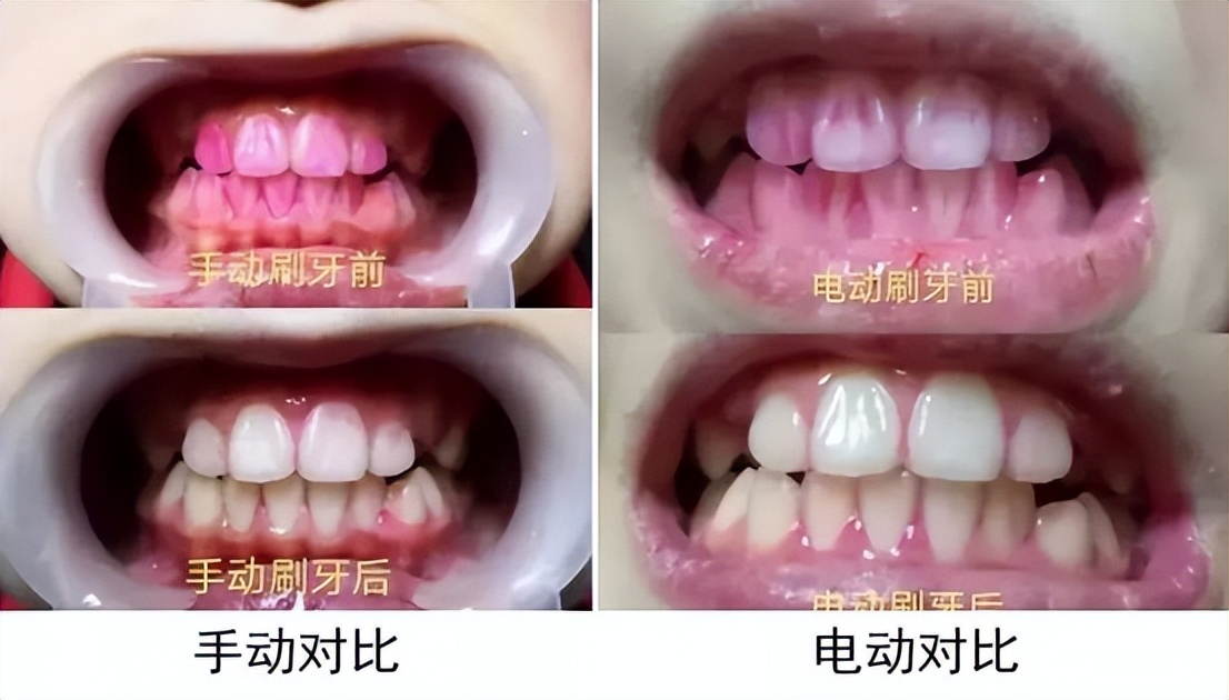 飞利浦usmile电动牙刷哪个更好,欧乐b和飞利浦扉乐电动牙刷评测