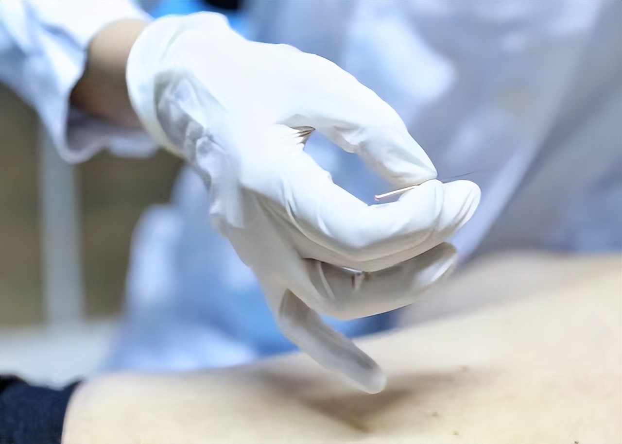 独到的肖氏刃针：中医非药物疗法，有效疏通人体“水管道”！