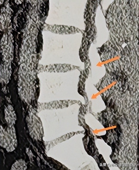 腰间盘突出压迫腿疼怎么治疗,腰间盘突出坐骨神经痛左臀酸痛