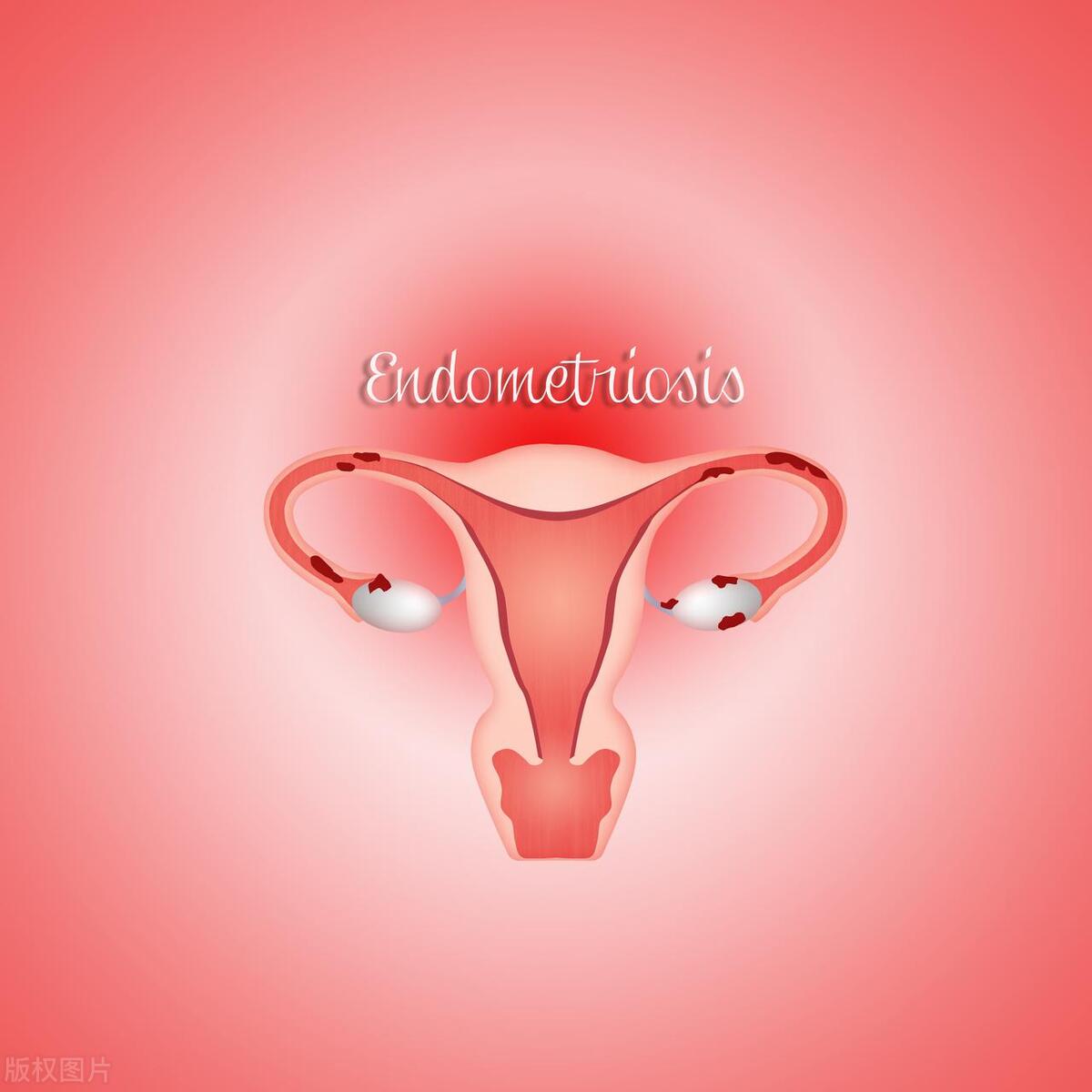 内膜增厚到多少容易得子宫内膜癌,子宫内膜增厚不规则出血就是癌吗