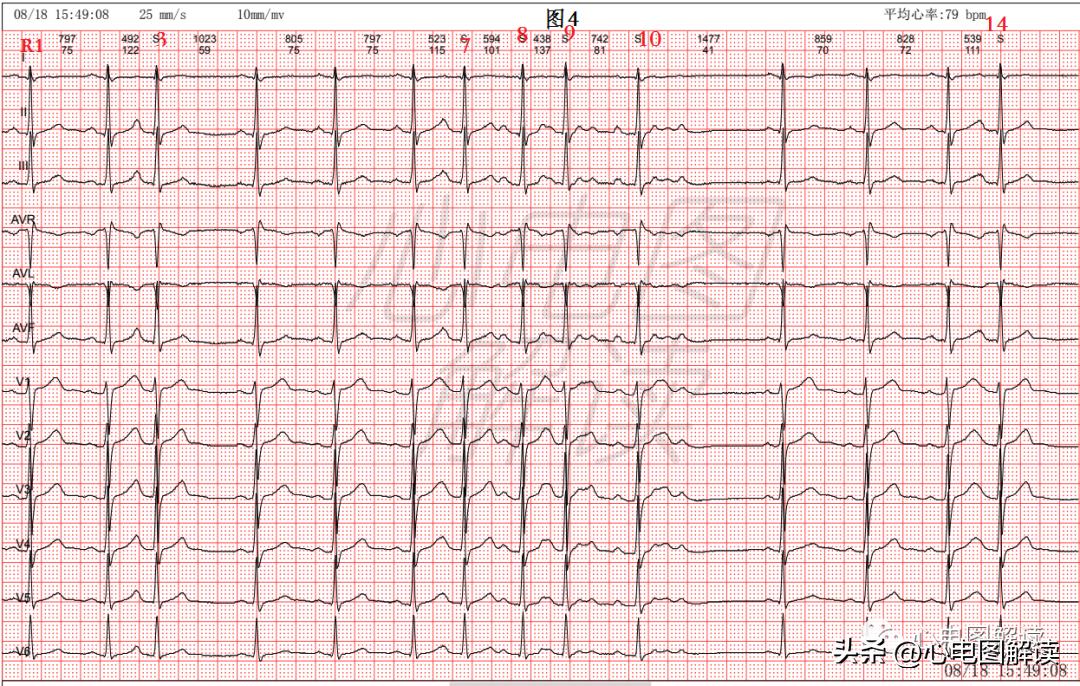 房早室早区别,房早室早房颤