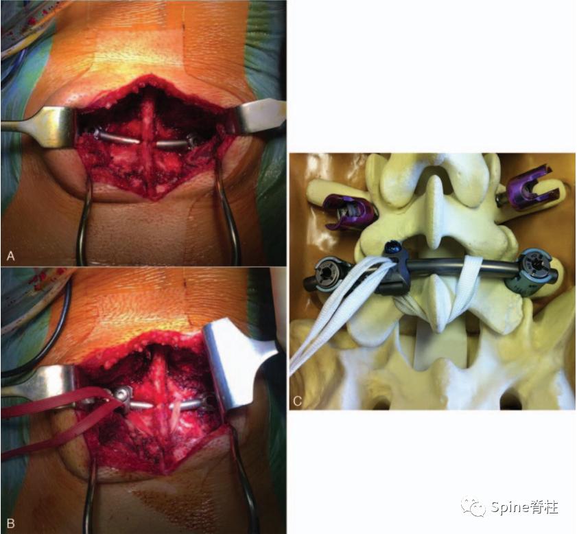 轻度峡部裂和重度峡部裂的区别,真性峡部裂和假性峡部裂