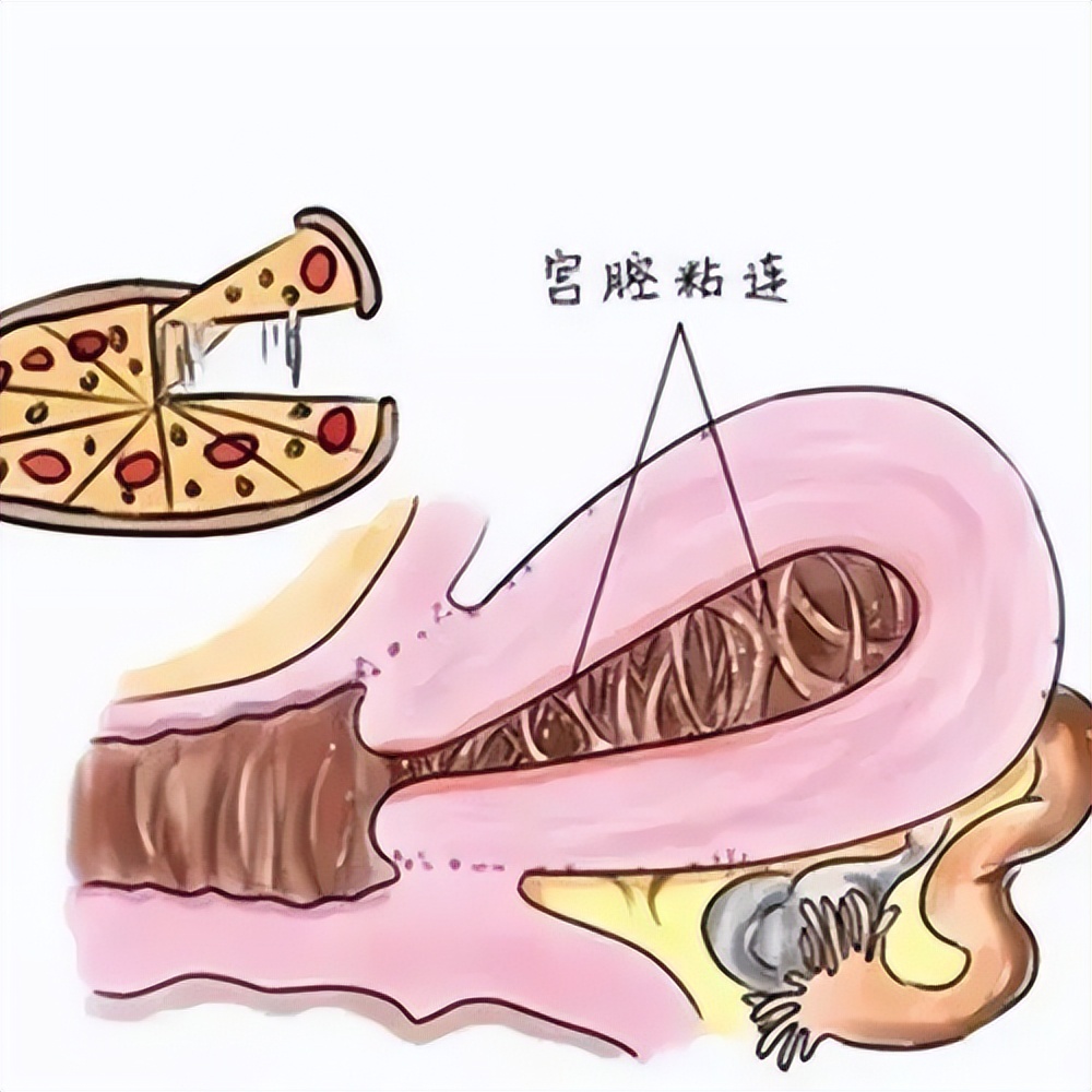 宫腔中下段妊娠会粘连吗,怀孕后宫腔粘连有影响吗