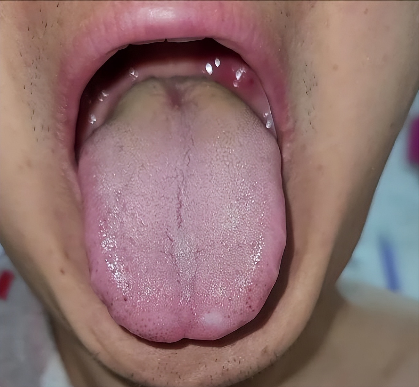 舌根高凸，舌苔黄腻，舌头尖上有红点，这些都是怎么回事？