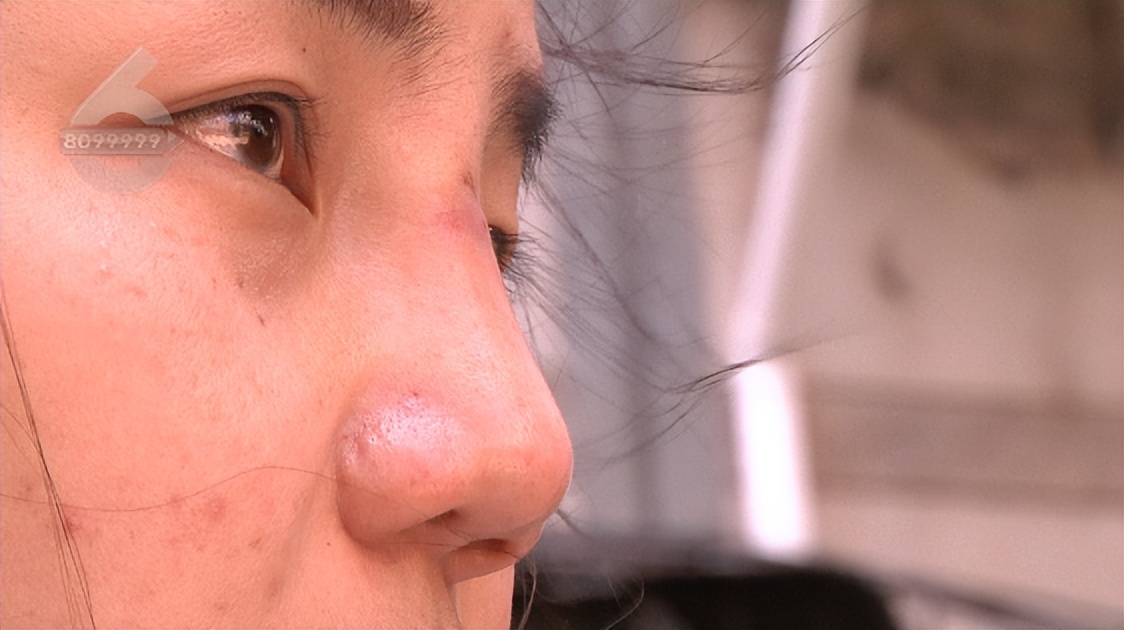 鼻子整形后流脓是不是医疗事故,鼻子整容后流脓怎么处理