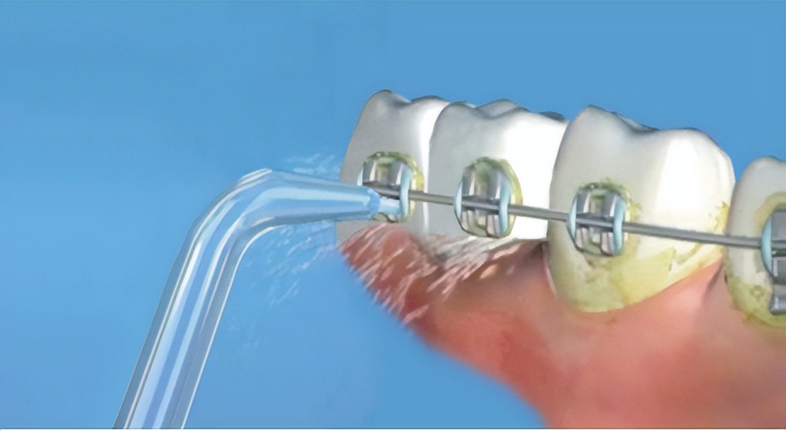 冲牙器的危害有哪些,冲牙器长期使用有危害吗