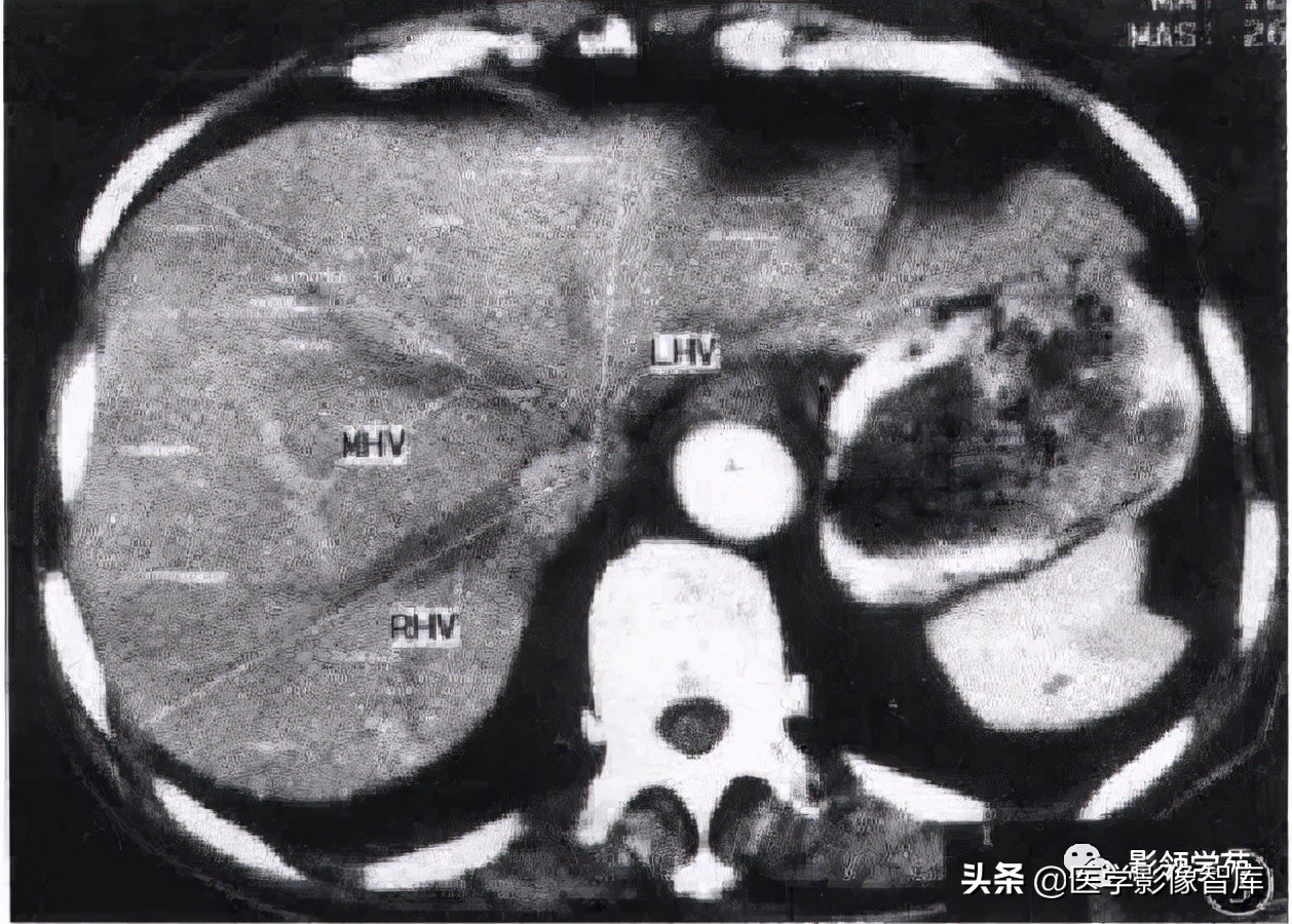 肝脏影像分叶分段解剖图,肝脏分段解剖图谱