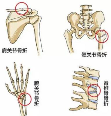骨质疏松性骨折最常见的部位,发生骨质疏松骨折最常见的部位