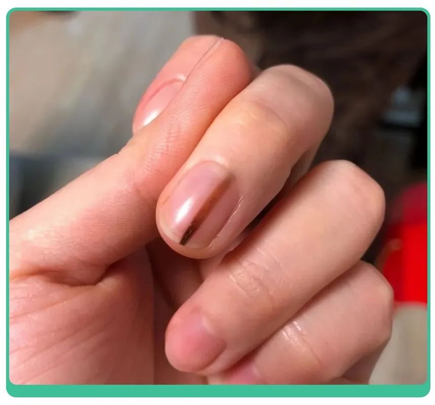 白斑、薄脆、凹陷，娃指甲有异常，不是缺营养，可能暗藏疾病