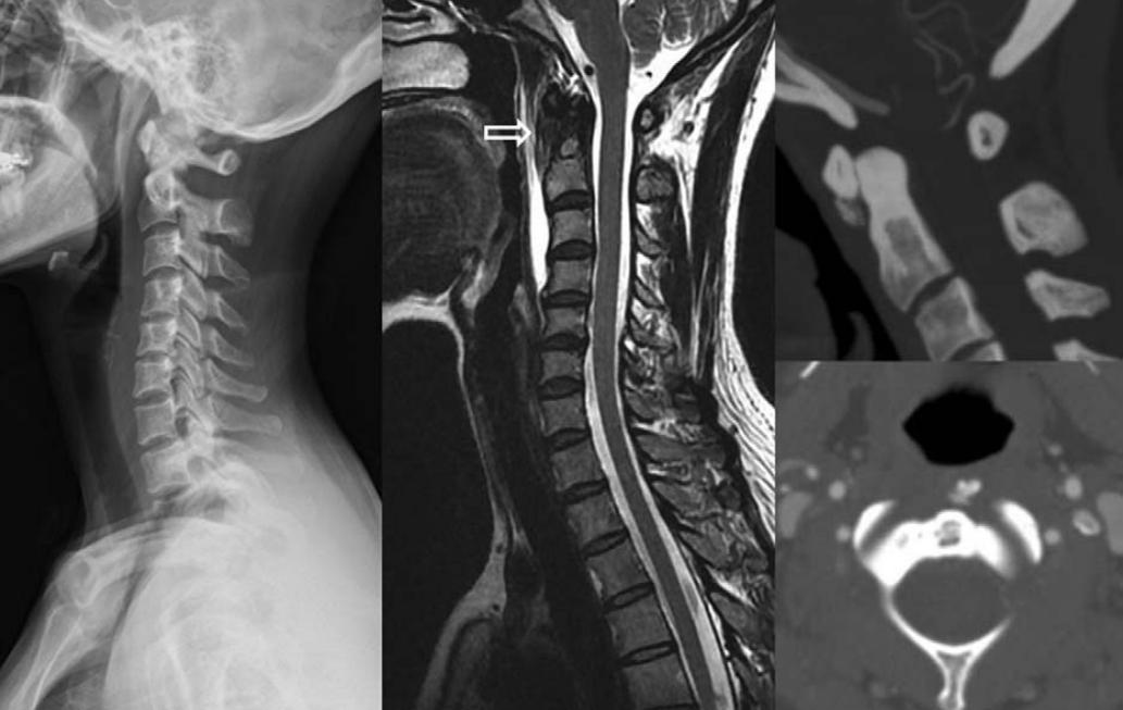 颈长肌腱炎影像表现,三头肌钙化性肌腱炎治疗