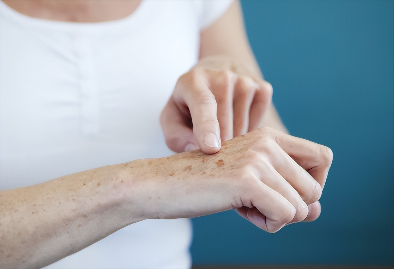 牙膏与红霉素软膏能祛老年斑吗,老年斑消除偏方红霉素软膏加甘油